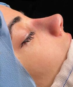 Rinoplastia 