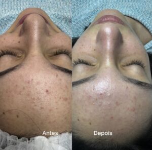 Limpeza de pele antes e depois